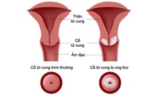 Cách kiểm tra ung thư cổ tử cung