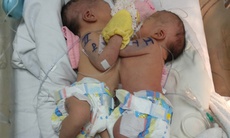 Mổ tách rời 2 bé sơ sinh dính nhau