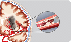 Tăng huyết áp: cảnh giác với đột quỵ