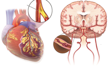 Đột quỵ có phải là cơn đau tim?
