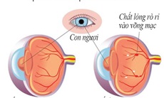 Biến chứng mắt do đái tháo đường