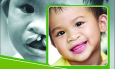 Phẫu thuật miễn phí cho 1.000 trẻ hở môi, hàm ếch