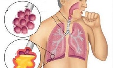 Nấm phổi: Thường gặp nhưng dễ bỏ qua
