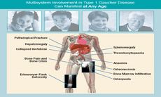 Thuốc mới điều trị bệnh di truyền gaucher hiếm gặp