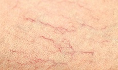 Giãn tĩnh mạch - bệnh hay gặp nhưng nhiều biến chứng