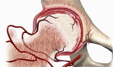 Cảnh giác với hoại tử loạn dưỡng xương đùi