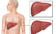 Các thuốc gây độc cho gan