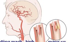 Hẹp động mạch cảnh có liên quan tới trí não