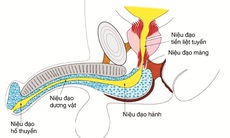 Hẹp niệu đạo