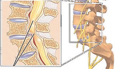 Nguyên nhân hẹp ống sống vùng thắt lưng