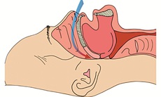 Hội chứng ngưng thở khi ngủ