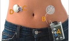 Máy bơm insulin kéo dài cuộc sống bệnh nhân đái tháo đường