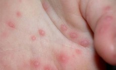 Để bé yêu không mắc các bệnh truyền nhiễm