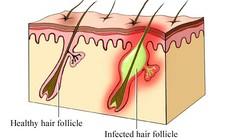 Thuốc trị bệnh viêm nang lông