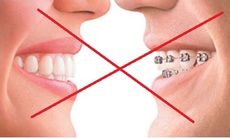 Điều Trị Hàm Hô Không Cần Niềng Răng