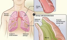 Có thể dự phòng được bệnh giãn phế quản?