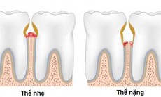 Chớ xem thường bệnh viêm lợi