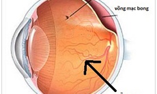 Ai dễ bị bong võng mạc?