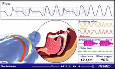 Rối loạn ngưng thở khi ngủ