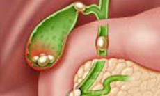 Nguyên nhân nào gây sỏi mật?