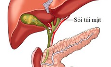 Sỏi túi mật – phẫu thuật hay chung sống hòa bình