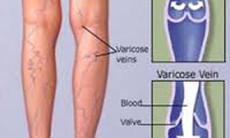 Biểu hiện suy tĩnh mạch chi dưới