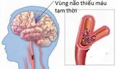 Cảnh giác với cơn thiếu máu não thoáng qua