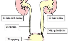 Thận ứ nước cần kiêng gì?