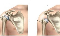 Ứng dụng nội soi điều trị trật khớp vai tái diễn