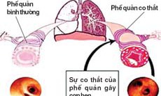 Bố bị hen phế quản có lây cho con không?