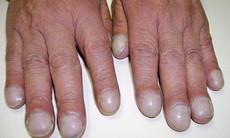 Viêm nội tâm mạc và biến chứng nguy hiểm