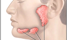 Sỏi tuyến nước bọt