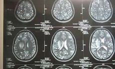 Ăn nem thính bị sán lợn làm tổ trong não