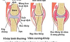 Viêm xương khớp: chữa thế nào?