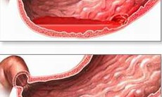 Viêm loét đại trực tràng chảy máu: Bệnh không thể xem nhẹ