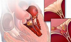 Để “liếm” khớp không “đớp” tim