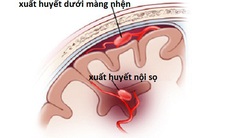 Bạn biết gì về xuất huyết mạch não dạng bột?