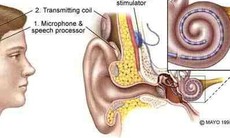 Điếc có chữa được