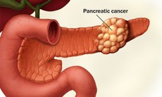 6 bộ phận trên cơ thể người dễ bị ung thư nhất