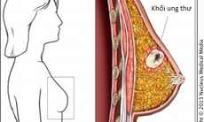 Thuốc mới cho phụ nữ mãn kinh bị ung thư vú tiến triển