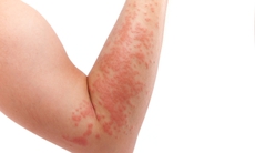 Bỏng da vì tự chữa eczema