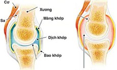 Bệnh viêm khớp phản ứng và viêm mắt