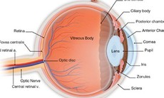 Cấy cảm biến điện tử để theo dõi thay đổi áp lực nhãn cầu