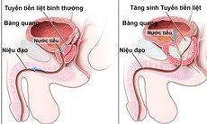 Tăng sinh lành tính tuyến tiền liệt là gì?