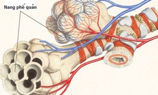 Bệnh nang phổi bẩm sinh là gì?