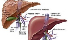 Tỉ lệ sống sót sau cấy ghép gan?
