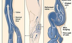 Cách chữa bệnh về tĩnh mạch ít đau, không sẹo
