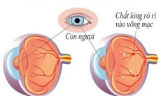 Tiểu đường hại mắt thế nào?