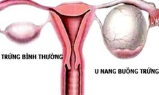 U nang buồng trứng