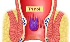 Nguyên nhân gây trĩ nội